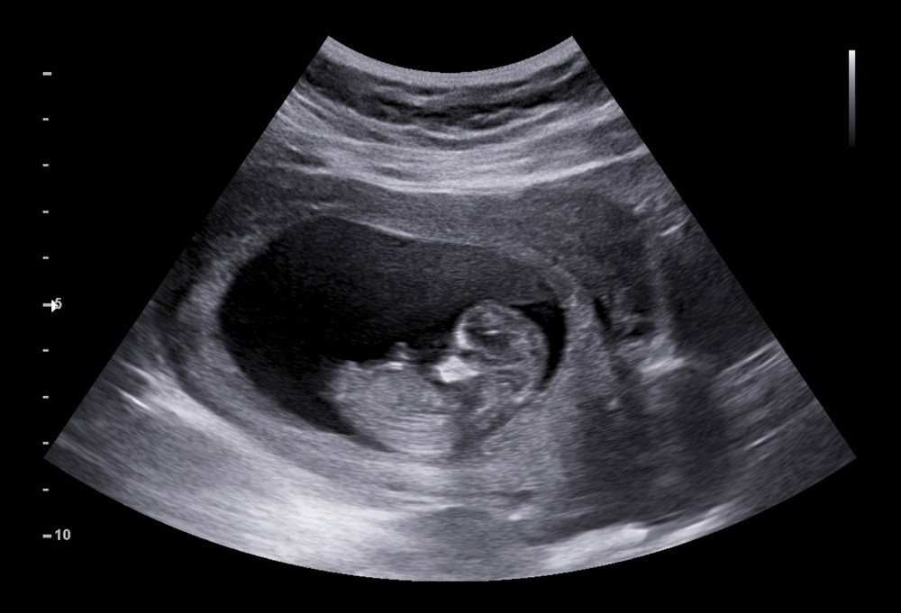 ECOGRAFIA FETO NEONATO BAMBINO ABORTO