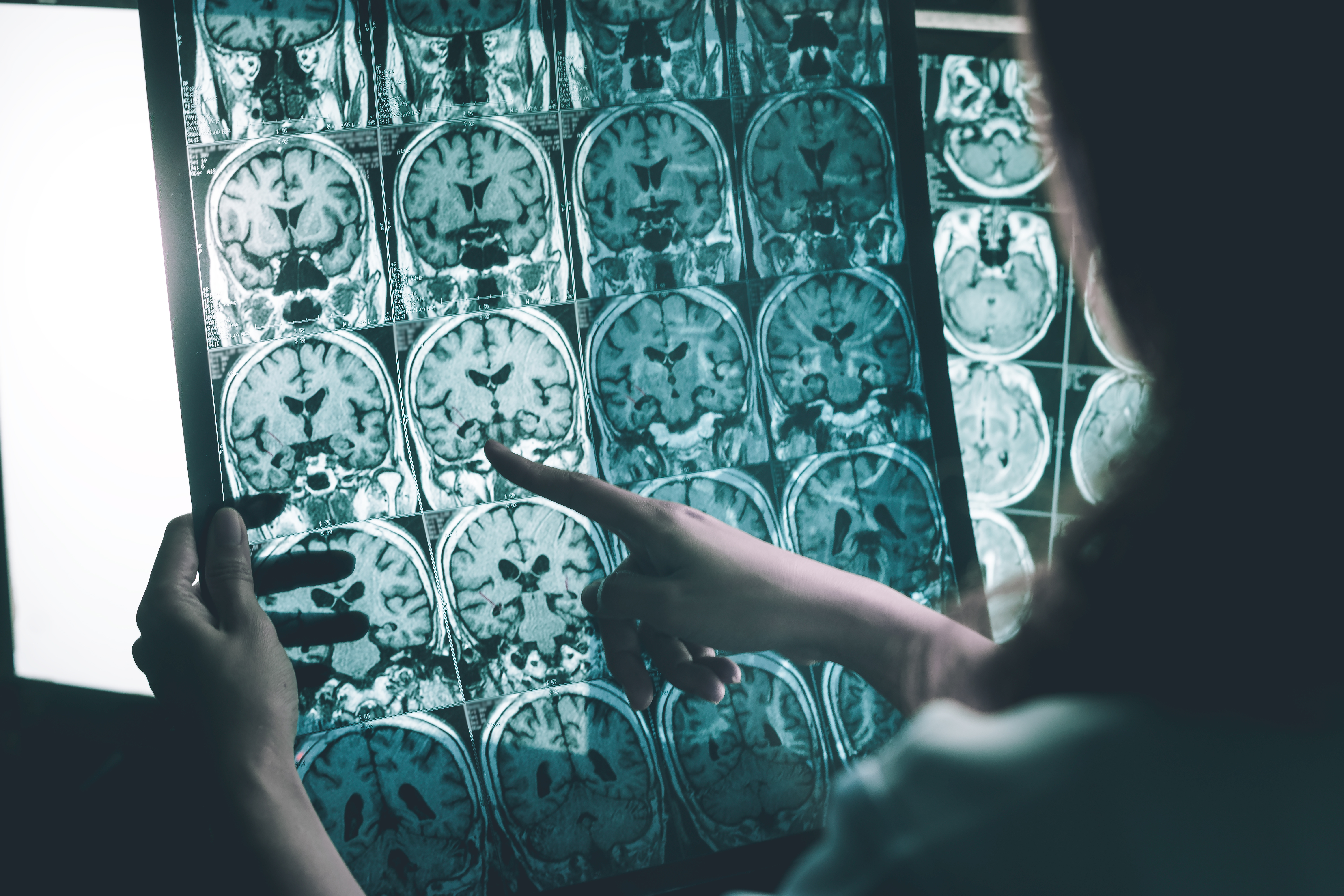 alzheimer